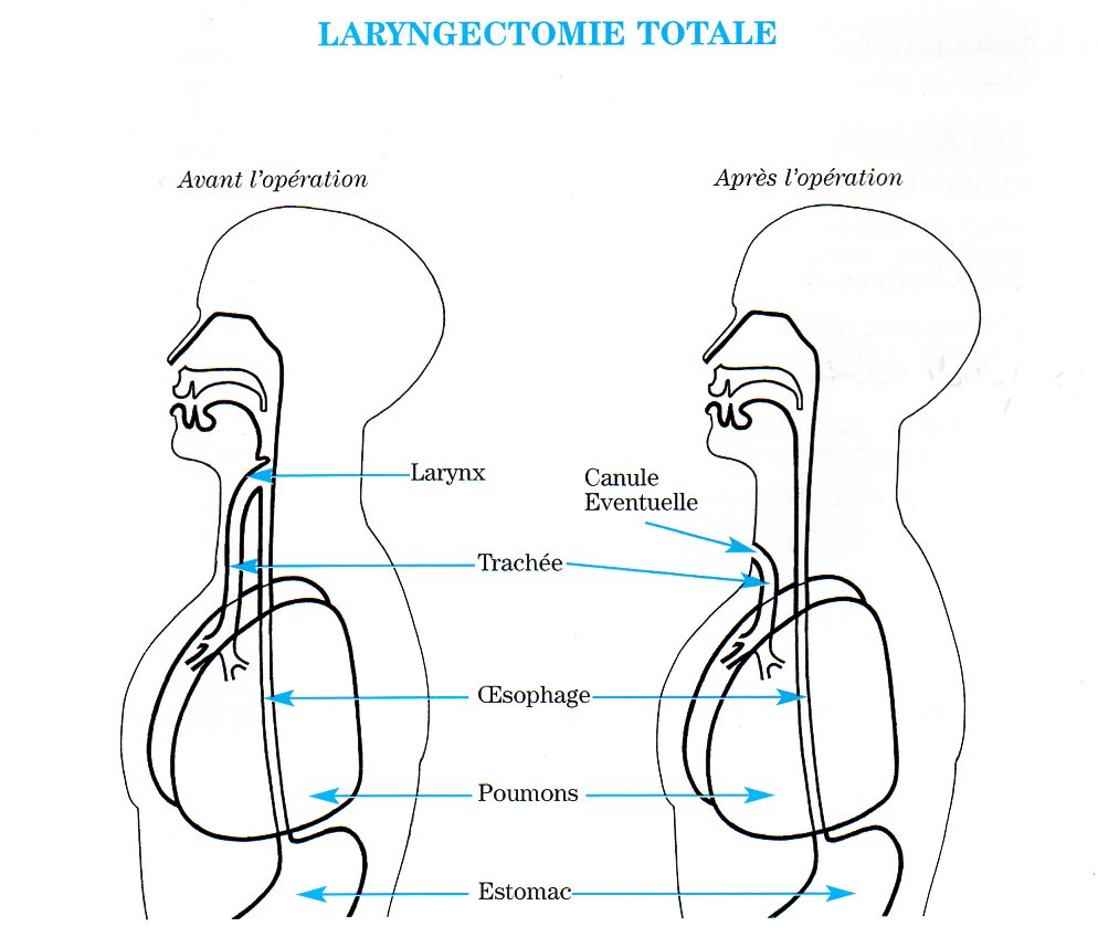 La Laryngectomie – Ma Voix Rhône-Alpes Auvergne