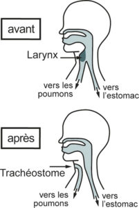 Ma Voix - Mutilés de la Voix - Rhone Alpes Auvergne. Laryngectomie - cancer du larynx - accompagnement